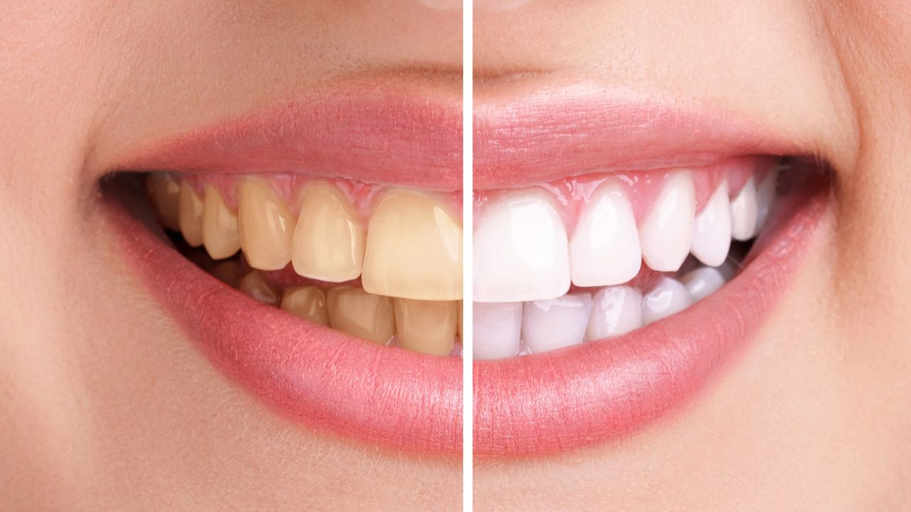 Blanchiment dentaire