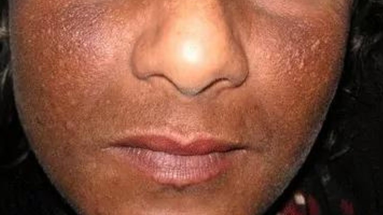Dépigmentation cutanée